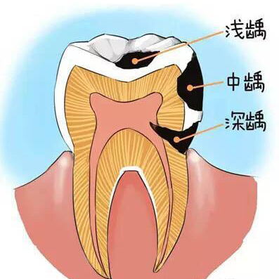小鞋带(美学修复)