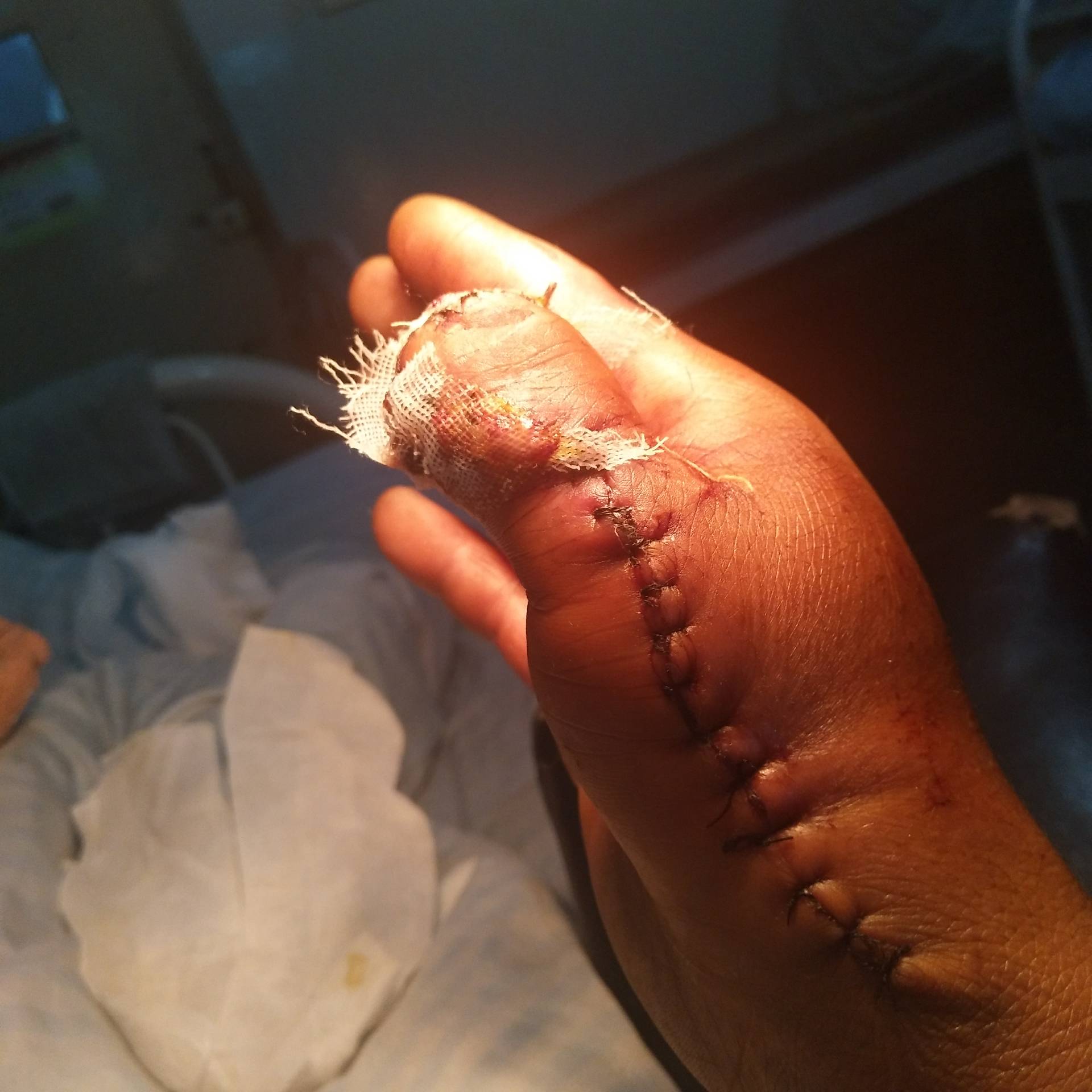 受伤的手 - 奋斗0215的快手