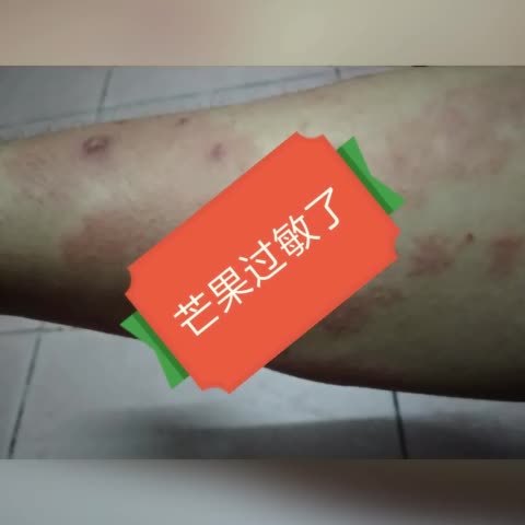 芒果过敏了 41       赞       4天前