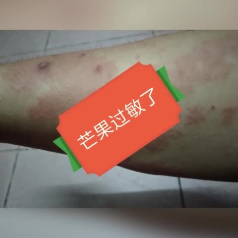 芒果过敏了 569       赞        15天前